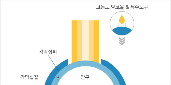 라식 VS 라섹