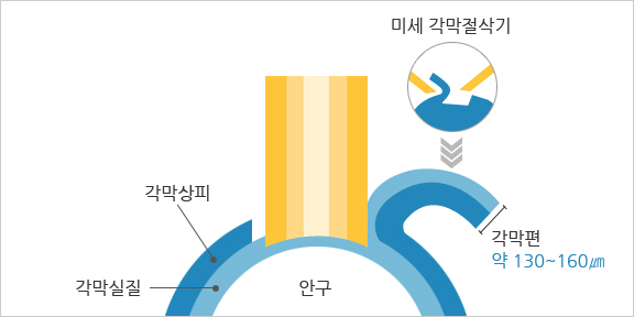 라식 VS 라섹