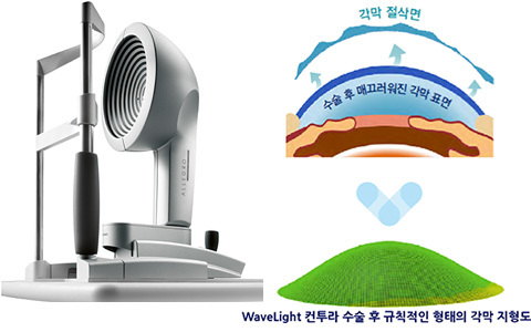 라식 VS 라섹