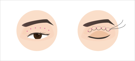 쌍꺼풀수술